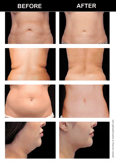 What exactly is BODY CONTOURING?