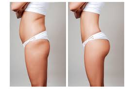 Can Vacuum Therapy Grow your Booty?