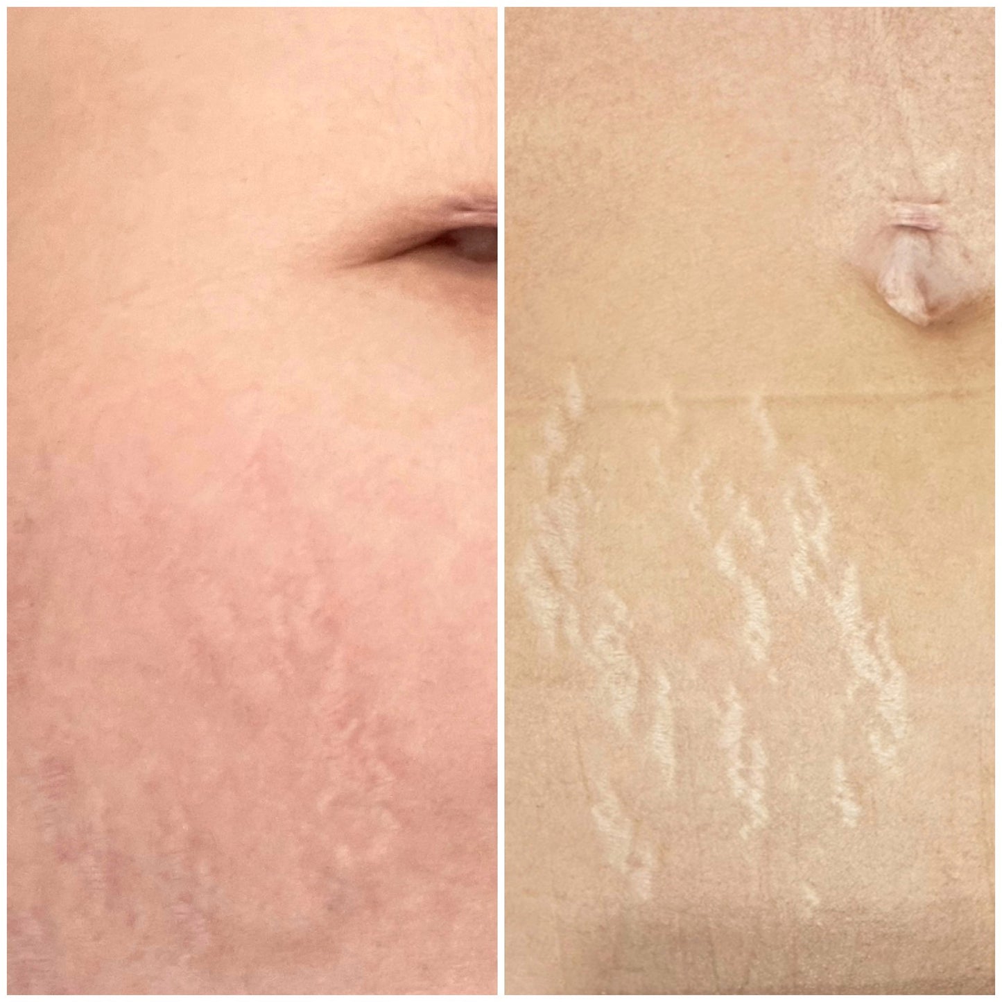 Non Surgical Mommy Makeover