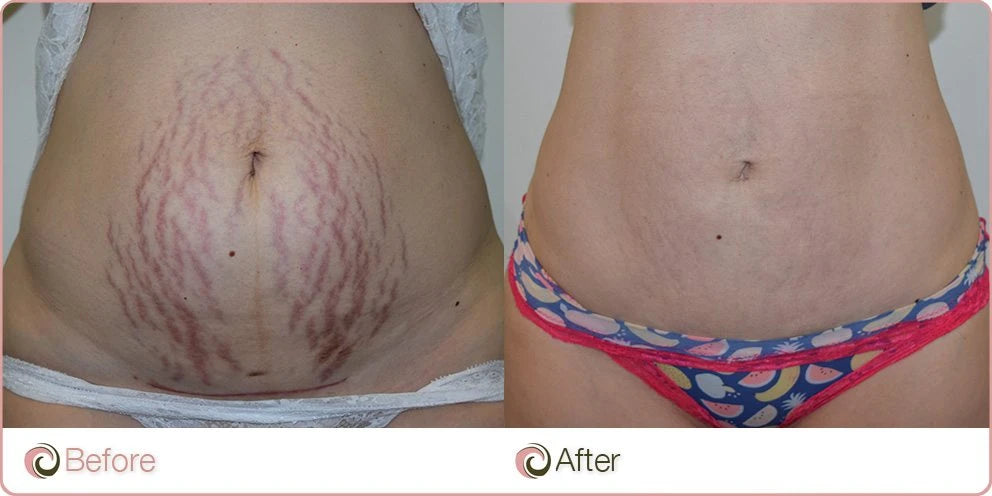 Non Surgical Mommy Makeover